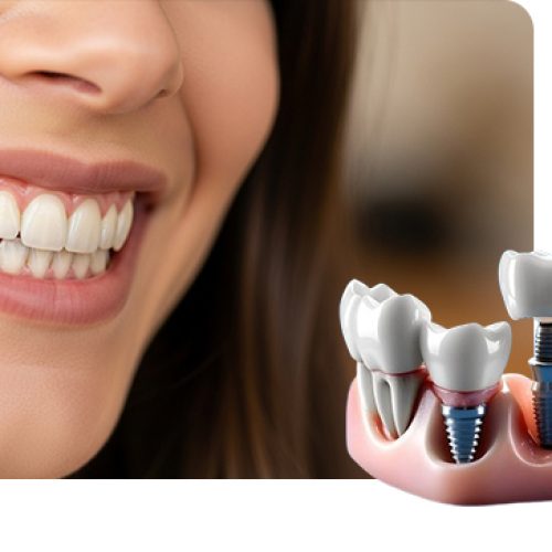 Dental implants procedure at Dr. Panjiar’s Dental Centre