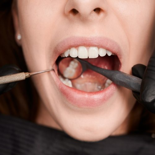 🦷 Healthy gums, healthy smile!
Restore your oral health with advanced periodontal flap surgery at Dr. Panjiar’s Dental Centre, the best dental clinic in Hadapsar. 🌿
Because strong gums mean a confident smile! 😁✨